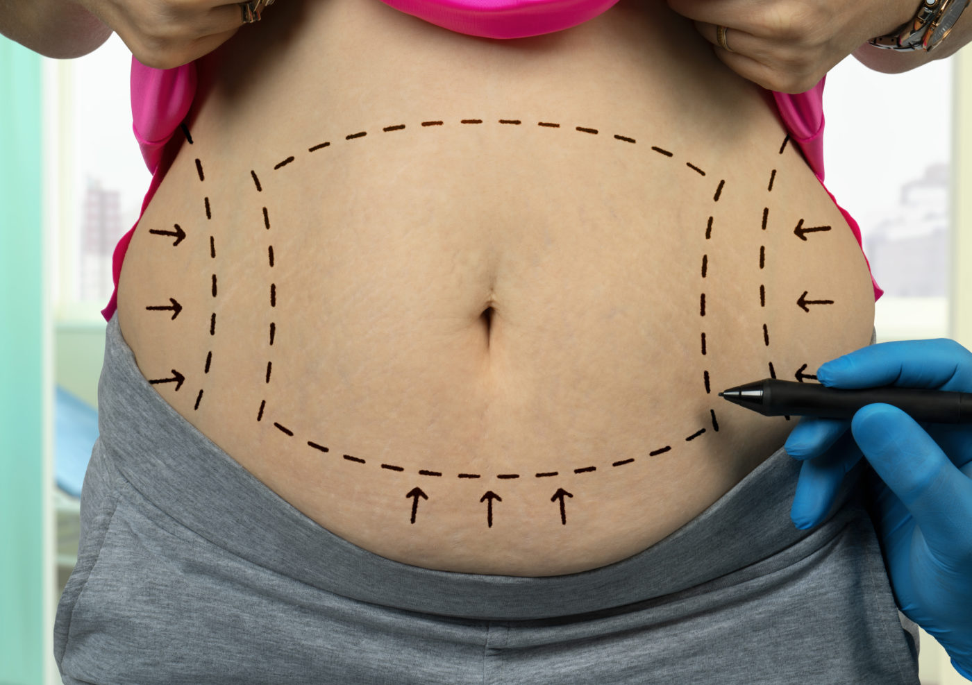 Chirurgie abdominale