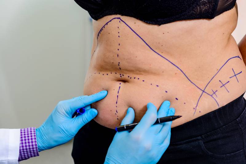Liposuccion abdominale