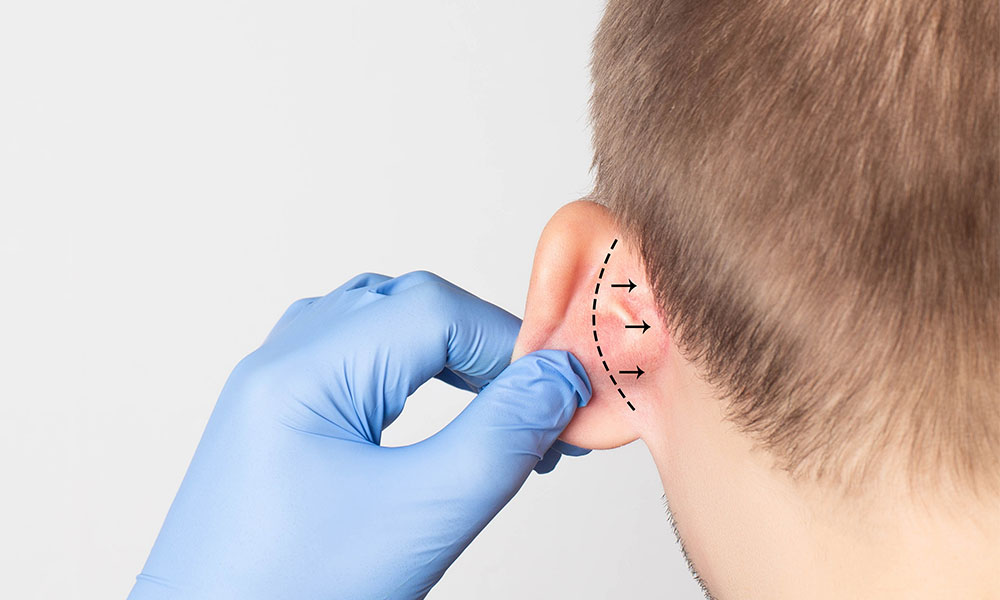 Otoplastie oreilles decollees enfant adulte prix