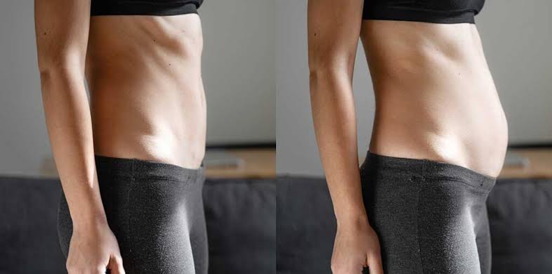 Diastasis des grands droits