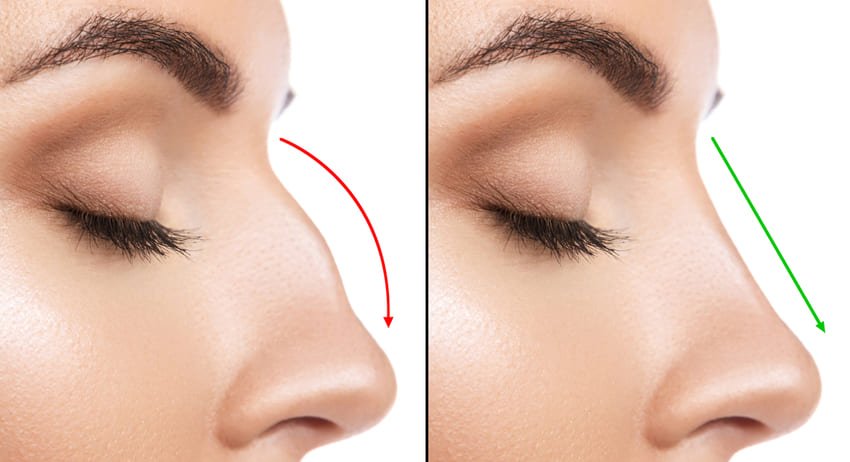 Rhinoplastie secondaire chirurgie de r&eacute;vision nez
